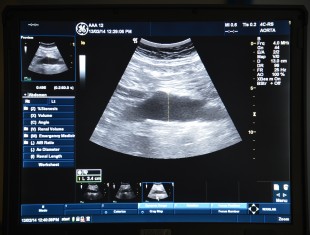 An ultrasound scan showing the abdominal aorta.