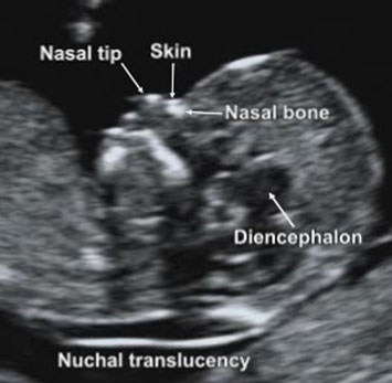 The nuchal translucency measures the fluid at the back of the babys neck and.