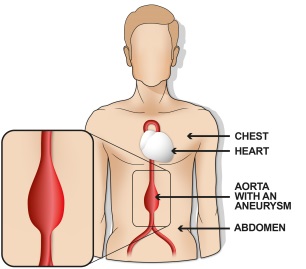 Diagram showing an aorta with an aneurysm.