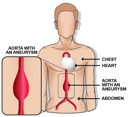 A diagram demonstrating what an abdominal aortic aneurysm looks like.