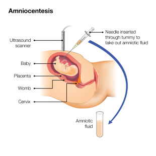 An illustration of the amniocentesis test. A needle is inserted through the tummy to take out amniotic fluid. This fluid is put into a test tube.