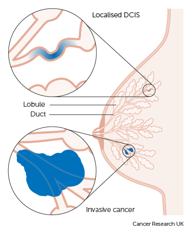 An illustration of localised DCIS and an invasive cancer.