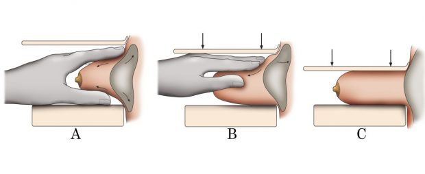 Images of a hand and a breast which demonstrate the Eklund technique