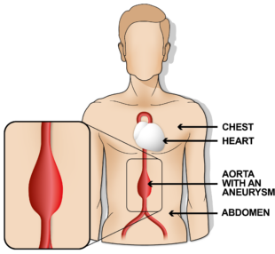 Illustration of an aorta with an aneurysm