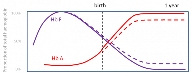 Graph showing how haemoglobin gradually changes from the fetal form to the adult form during the first year of life. Graph includes 4 lines – a solid purple line (fetal form of haemoglobin (HbF) for most individuals), a dashed purple line (HbF for individuals with HPFH), a solid red line (adult form of haemoglobin (HbA) for most individuals) and a dashed red line (HbA for individuals with HPFH. The graph shows levels of HbF making up 100% of total haemoglobin during early pregnancy, then slowly declining to less than 1% of total haemoglobin by the time most individuals are one year old, but more than that for individuals with HPFH. Levels of HbA, in contrast, increase from 0% in early pregnancy to more than 99% in most individuals by one year of age