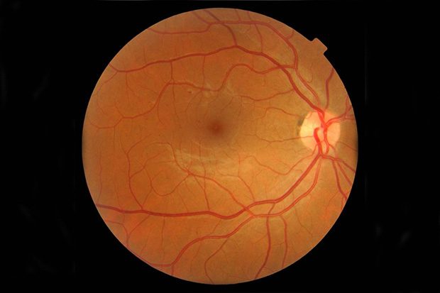 A digital photograph of a retina