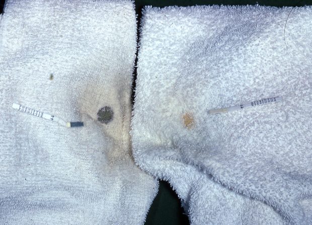 Two cloth nappies - one showing a positive urine (Phenistix) test for phenylketonuria, one showing a negative test