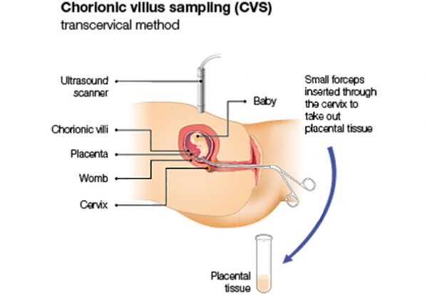 Illustration from the online information for parents showing the transcervical method for chorionic villus sampling