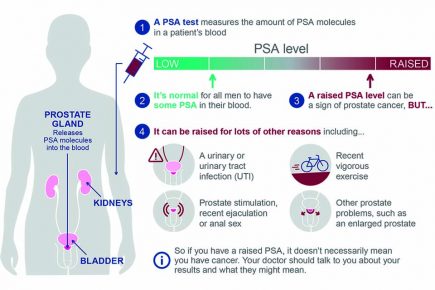 Guidance updated on PSA testing for prostate cancer – PHE Screening