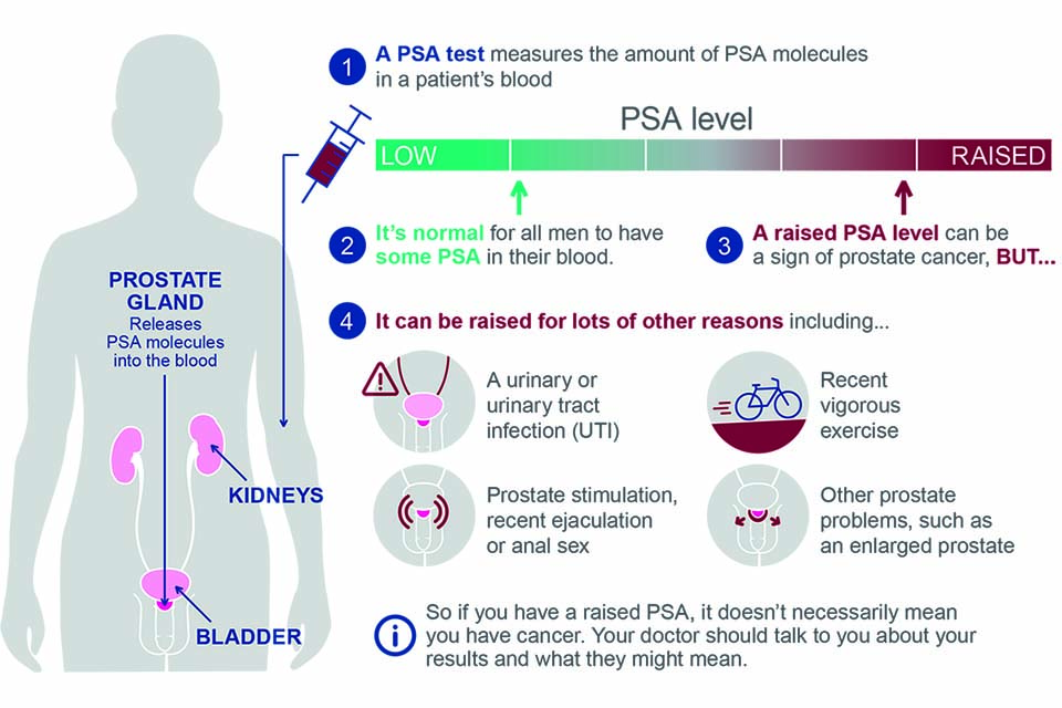 Prostate Cancer Exam