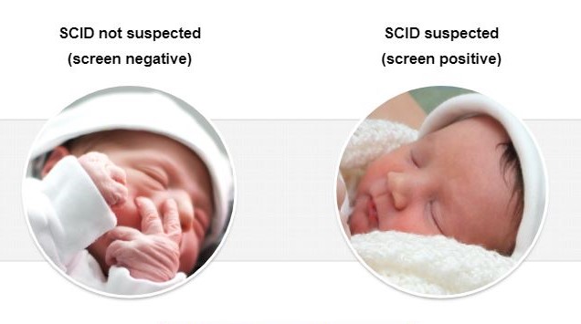 scid newborn screening